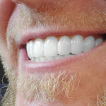 LENTE DE CERÂMICA DENTÁRIA - SMILEFLEX™