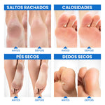 TRATAMENTO COM MEIAS ESFOLIANTES PARA PÉS COM CALOSIDADES - FeetPeel™