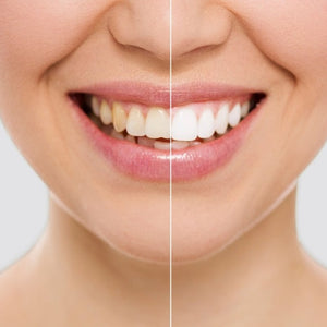 LÁPIS DE BRANQUEAMENTO DENTAL COM FÓRMULA MELHORADA - SMILE WHITE™